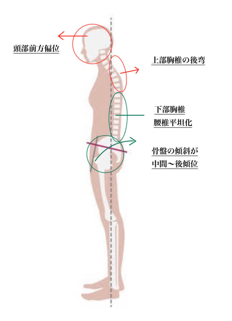 悪い姿勢 – フラットバック型とは？ | 光幸はりきゅう院・接骨院