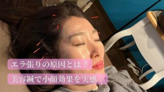 エラ張りの原因とは？美容鍼で小顔効果を実感☆