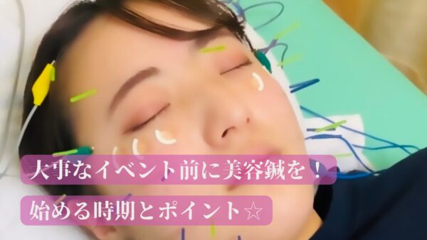 大事なイベント前に美容鍼を！始める時期とポイント☆