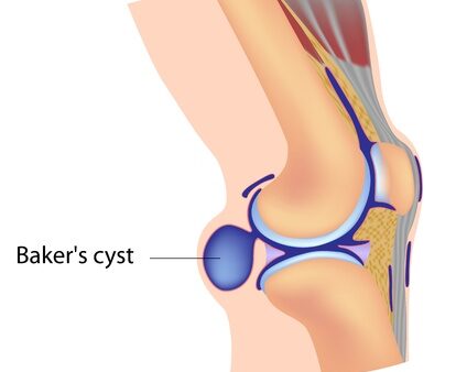 ベーカー嚢腫ってなに？症状・原因などを解説！